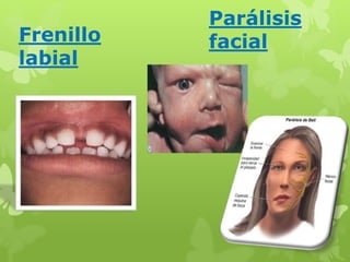 Frenillo 
labial 
Parálisis 
facial 
 