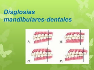 Disglosias 
mandibulares-dentales 
 