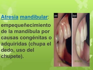 Atresia mandibular: 
empequeñecimiento 
de la mandíbula por 
causas congénitas o 
adquiridas (chupa el 
dedo, uso del 
chupete). 
 