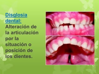 Disglosia 
dental: 
Alteración de 
la articulación 
por la 
situación o 
posición de 
los dientes. 
 