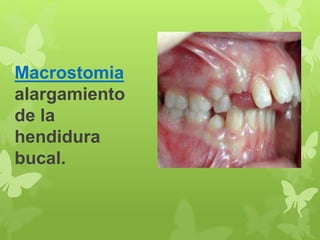 Macrostomia 
alargamiento 
de la 
hendidura 
bucal. 
 