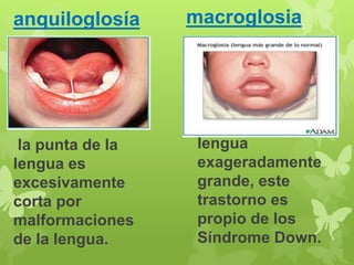 anquiloglosía 
la punta de la 
lengua es 
excesivamente 
corta por 
malformaciones 
de la lengua. 
macroglosia 
lengua 
exageradamente 
grande, este 
trastorno es 
propio de los 
Síndrome Down. 
 