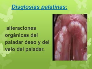 Disglosias palatinas: 
alteraciones 
orgánicas del 
paladar óseo y del 
velo del paladar. 
 