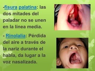 -fisura palatina: las 
dos mitades del 
paladar no se unen 
en la línea media. 
- Rinolalia: Pérdida 
del aire a través de 
la nariz durante el 
habla, da lugar a la 
voz nasalizada. 
 