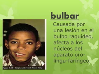 bulbar 
Causada por 
una lesión en el 
bulbo raquídeo, 
afecta a los 
núcleos del 
aparato oro-lingu- 
faríngeo. 
 