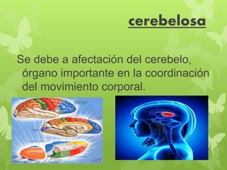 cerebelosa 
Se debe a afectación del cerebelo, 
órgano importante en la coordinación 
del movimiento corporal. 
 