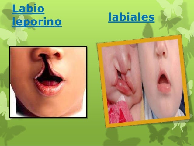 Resultado de imagen para LABIO LEPORINO, FRENILLO LABIAL, PARALISIS FACIAL