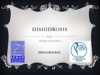 DISHIDROSIS

  DERMATOLOGIA



 DIEGO CRUZ RUIZ
 