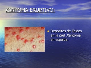 XANTOMA ERUPTIVO: Depósitos de lípidos en la piel .Xantoma en espalda. 
