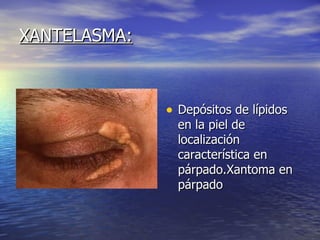 XANTELASMA: Depósitos de lípidos en la piel de localización característica en párpado.Xantoma en párpado 