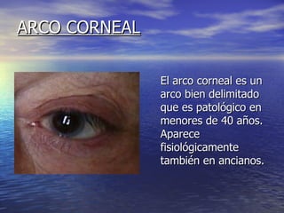ARCO CORNEAL El arco corneal es un arco bien delimitado que es patológico en menores de 40 años. Aparece fisiológicamente también en ancianos.  