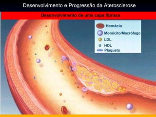 Desenvolvimento de uma capa fibrosa
Desenvolvimento e Progressão da Aterosclerose
 