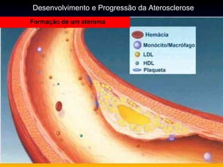 Formação de um ateroma
Desenvolvimento e Progressão da Aterosclerose
 