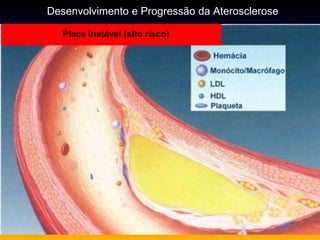 Placa Instável (alto risco)
Desenvolvimento e Progressão da Aterosclerose
 