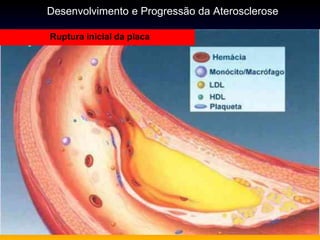 Ruptura inicial da placa
Desenvolvimento e Progressão da Aterosclerose
 