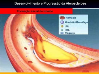 Formação inicial do trombo
Desenvolvimento e Progressão da Aterosclerose
 