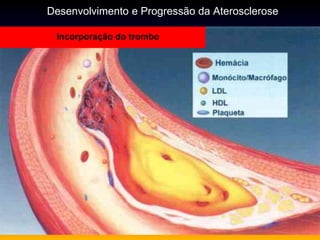 Incorporação do trombo
Desenvolvimento e Progressão da Aterosclerose
 