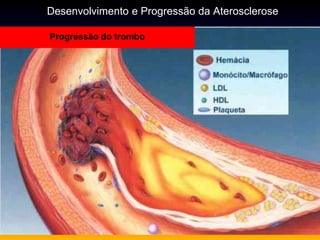 Progressão do trombo
Desenvolvimento e Progressão da Aterosclerose
 