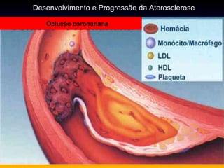 Oclusão coronariana
Desenvolvimento e Progressão da Aterosclerose
 