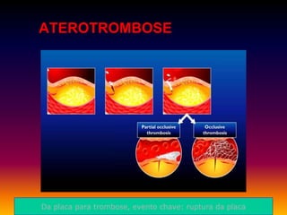 ATEROTROMBOSE
Da placa para trombose, evento chave: ruptura da placa
 