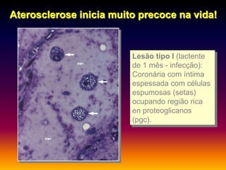 Lesão tipo I (lactente
de 1 mês - infecção):
Coronária com íntima
espessada com células
espumosas (setas)
ocupando região rica
en proteoglicanos
(pgc).
Aterosclerose inicia muito precoce na vida!
 