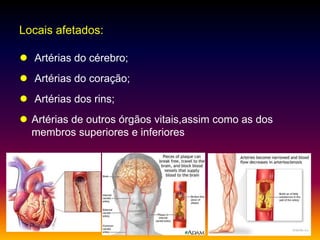 Locais afetados:
 Artérias do cérebro;
 Artérias do coração;
 Artérias dos rins;
 Artérias de outros órgãos vitais,assim como as dos
membros superiores e inferiores
 