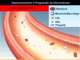 Desenvolvimento e Progressão da Aterosclerose
Artéria Coronária Normal
 