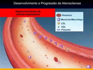 Desenvolvimento de
células esponjosas
Desenvolvimento e Progressão da Aterosclerose
 