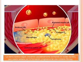 La estría lipidica sigue creciendo paulatinamente formando el núcleo lipídico,
 La estría lipidica sigue creciendo paulatinamente formando el núcleo lipídico,
   que queda aislada por la formación progresiva de una cubierta fibrosa.
    que queda aislada por la formación progresiva de una cubierta fibrosa.
 