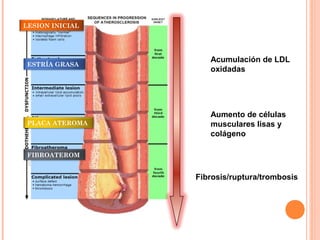 LESION INICIAL




                    Acumulación de LDL
 ESTRÍA GRASA
                    oxidadas




                    Aumento de células
 PLACA ATEROMA      musculares lisas y
                    colágeno

 FIBROATEROM
 A

                 Fibrosis/ruptura/trombosis
 