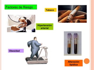 Factores de Riesgo
                           Tabaco




                     Hipertensión
                        arterial




  Obesidad



                                    Alteración
                                     lipídica
 