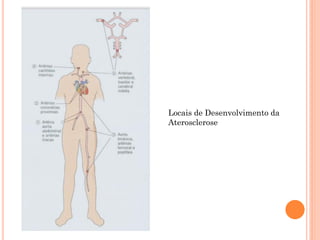 Locais de Desenvolvimento da
Aterosclerose
 