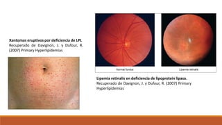 Lipemia retinalis en deficiencia de lipoprotein lipasa.
Recuperado de Davignon, J. y Dufour, R. (2007) Primary
Hyperlipide...