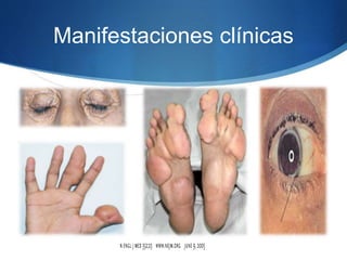 Manifestaciones clínicas
 