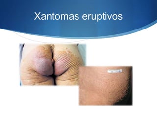 Xantomas eruptivos
 