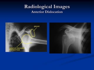 Radiological ImagesAnterior Dislocation