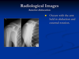 Radiological ImagesAnterior dislocationOccurs with the arm held in abduction and external rotation.
