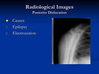 Radiological ImagesPosterior DislocationCausesEpilepsyElectrocution