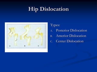 Hip DislocationTypes:Posterior DislocationAnterior DislocationCenter Dislocation