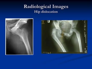 The patient has a flexion, adduction and medial rotational deformity of the affected limb.