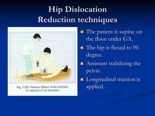 Hip movement grossly restricted.Radiological ImagesHip dislocation