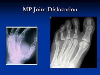 Elbow DislocationCommonly due to fall on outstretched hand.Closed reduction and long arm back slab for 3 wks is the treatment of choice.
