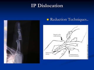 MP Joint Dislocation