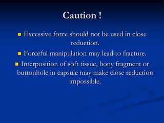 Caution !Excessive force should not be used in close reduction. Forceful manipulation may lead to fracture.Interposition of soft tissue, bony fragment or buttonhole in capsule may make close reduction impossible.