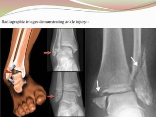 Radiographic images demonstrating ankle injury:-
 