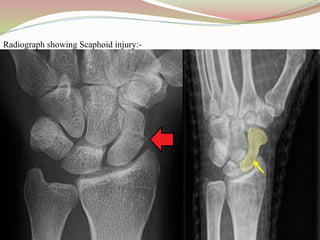 Radiograph showing Scaphoid injury:-
 