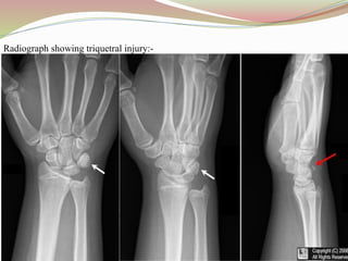 Radiograph showing triquetral injury:-
 
