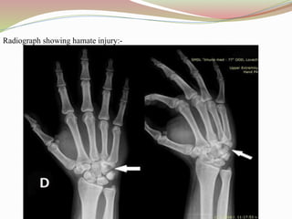Radiograph showing hamate injury:-
 