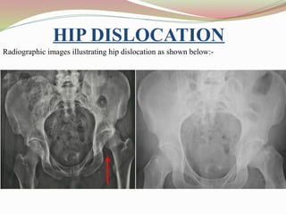 HIP DISLOCATION
Radiographic images illustrating hip dislocation as shown below:-
 
