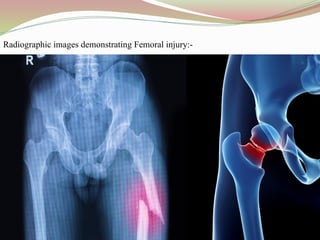 Radiographic images demonstrating Femoral injury:-
 